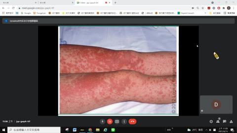 藥物疹與指甲疾病Part 2