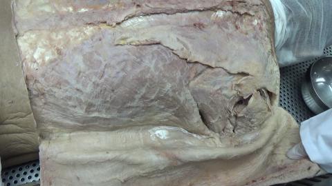 930 第一組 Scapular After.MP4