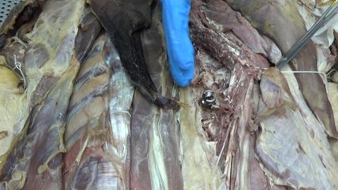 示範手術 II-打骨釘I.MP4