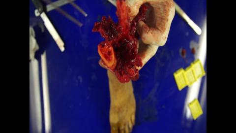 病肢與血管相關性